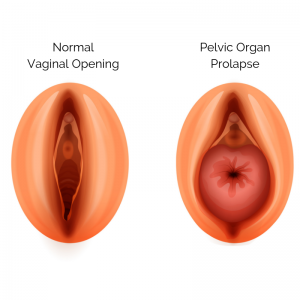 Prolapse of Vagina, Rectum or Uterus