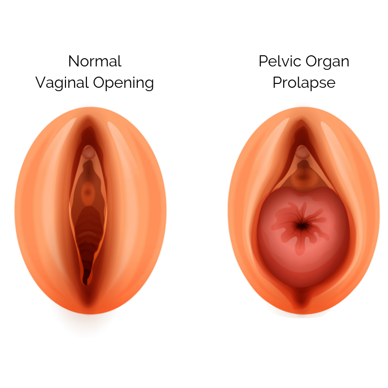 Pelvic Organ Prolapse: Types, Causes, Symptoms & Treatment