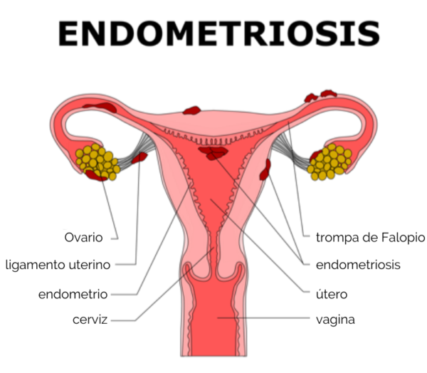 Endometriosis Foundation For Female Health Awareness 5618