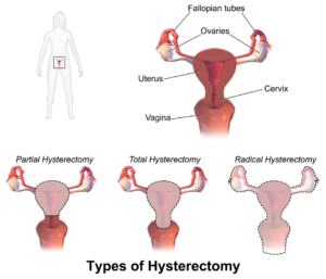 Hysterectomy